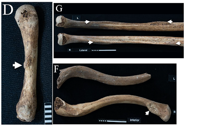 Images of finger, arm and collar bones