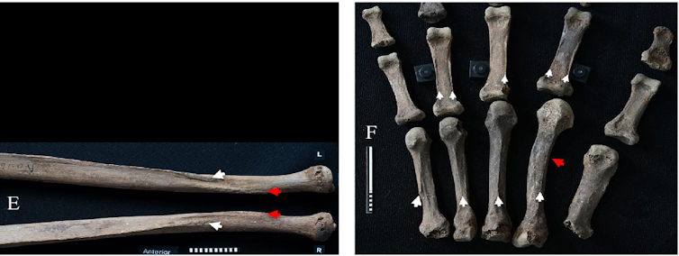 Images of arm and hand bones